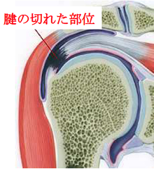 腱 板 断裂